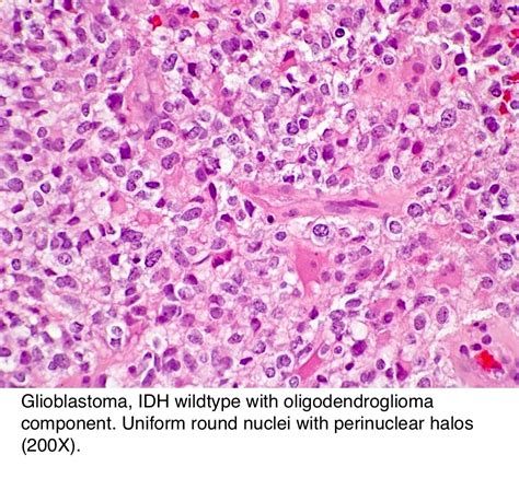 glioblastoma pathology outlines